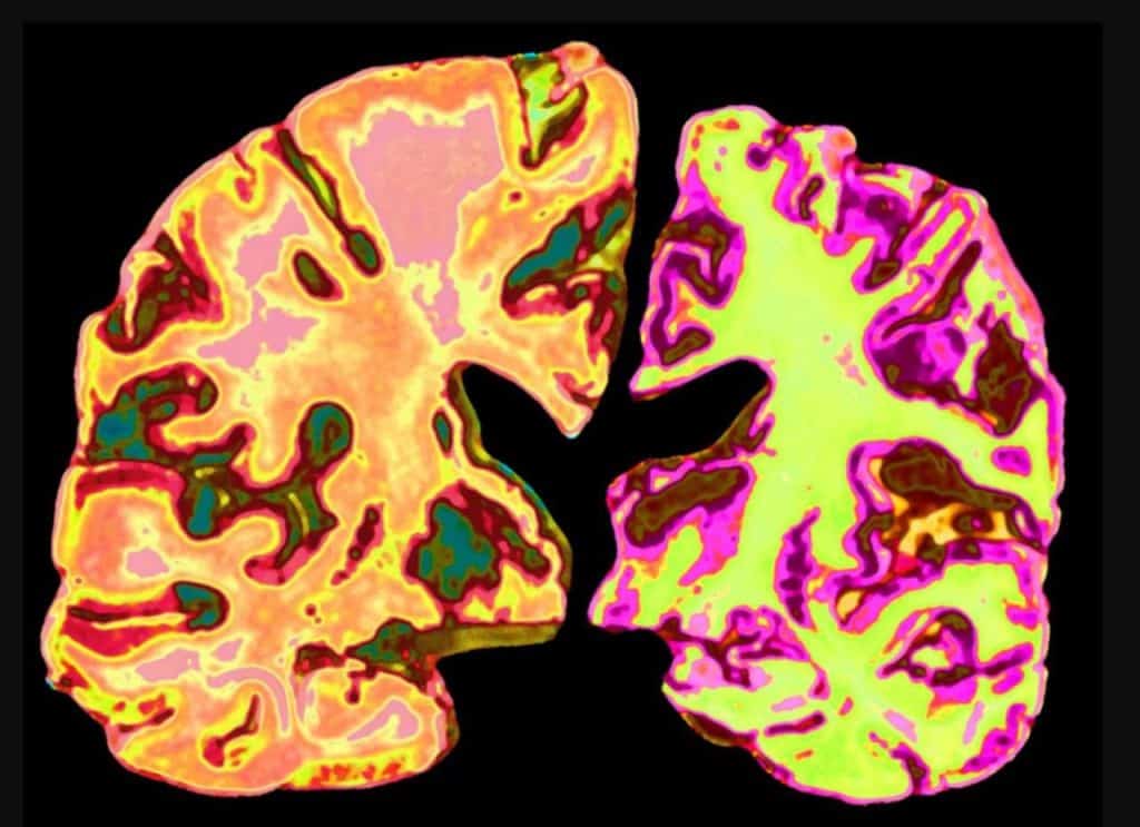 دراسة: انخفاض الليثيوم في الدماغ قد يساهم في تطور الزهايمر
